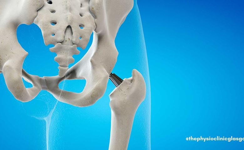 Hip Replacement